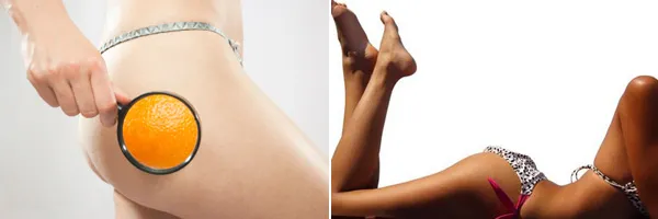Антицеллюлитный массаж
